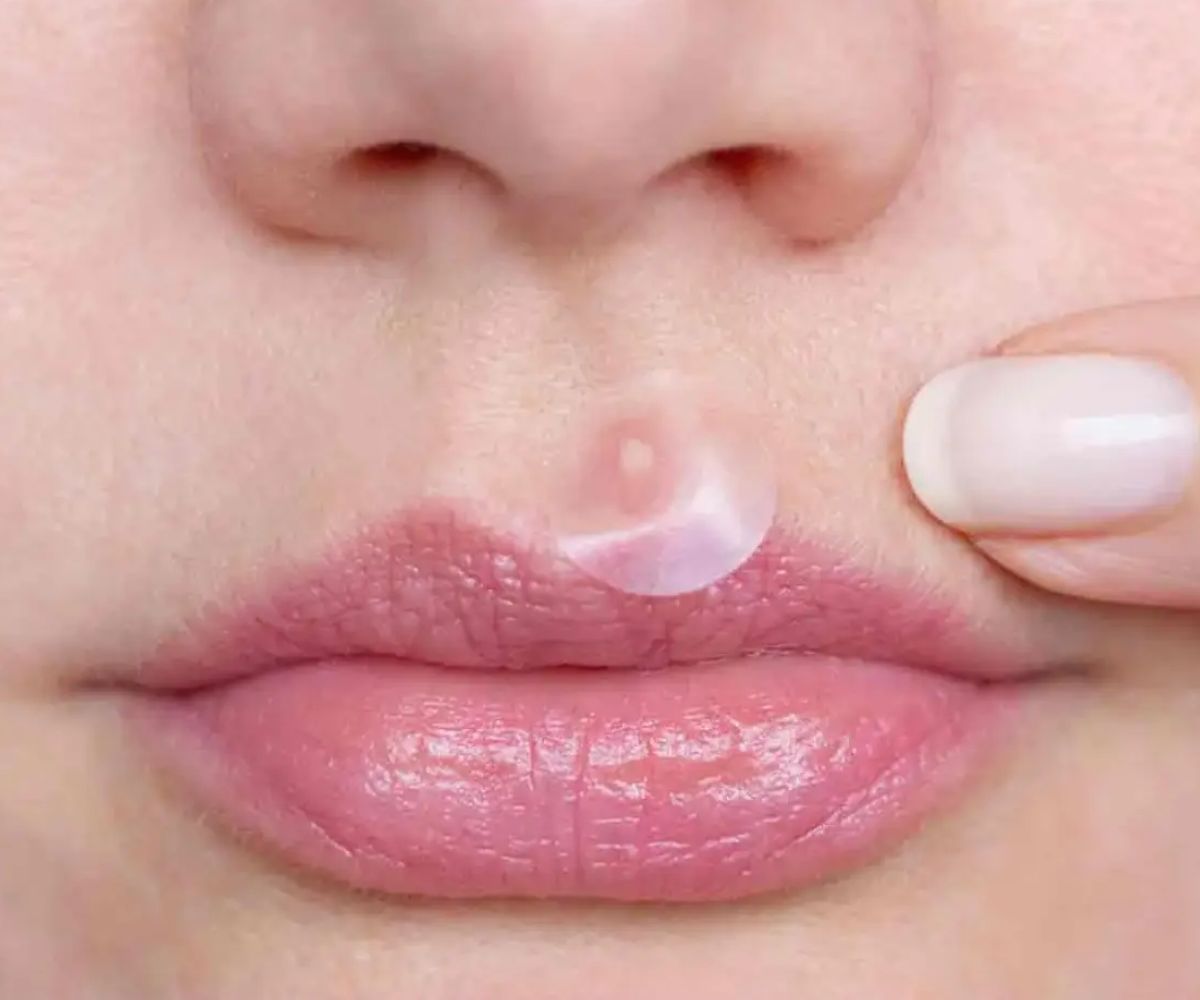 How to Get Rid of Pimple on Lip: Top Tips and Treatments