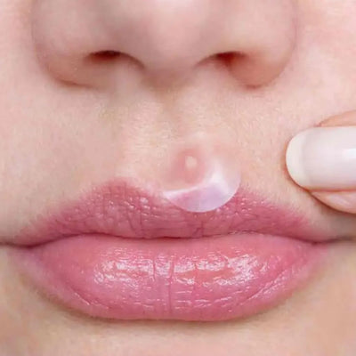 How to Get Rid of Pimple on Lip: Top Tips and Treatments